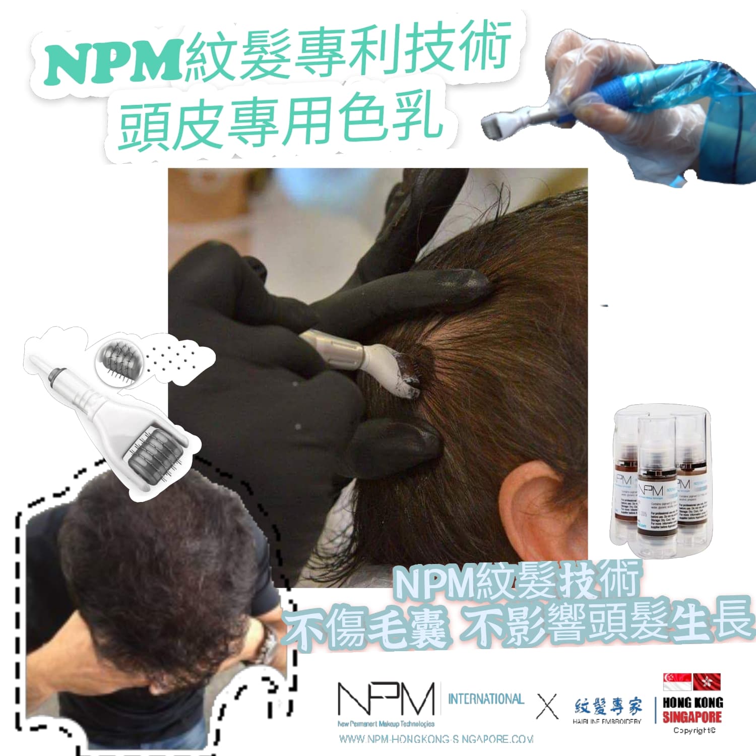 NPM紋髮專家 紋髮際線 紋髮線 香港紋髮