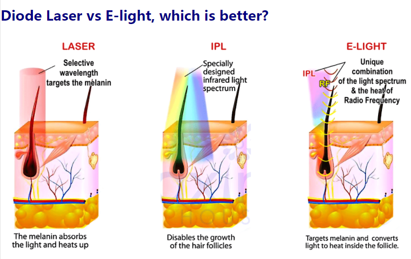 IPL or Diode Laser? Advantages of diode over IPL