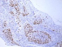 IHC-肺鳞癌ki67-M---生物素-G-M--链霉亲和素-HRP--2