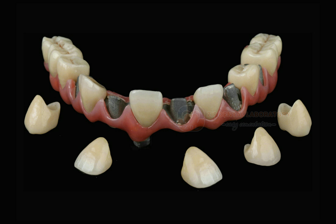 A04.CAD-CAMMilledFull-archImplantAbutmentBarwithCement-retainedSuperstructureProsthesis-03