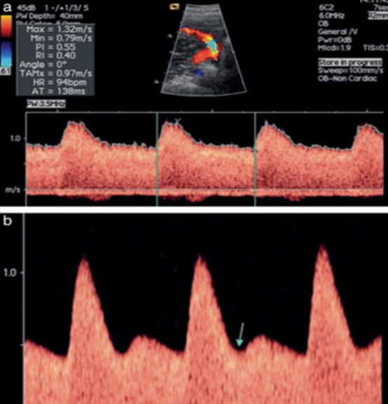 Doppler Measurement Of Uterine Arteries During Pregnancy Amain四川亚麦科技 Leader Supplier Of 7645