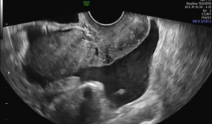 From a case of ruptured corpus luteum ovarian ultrasound manifestations ...