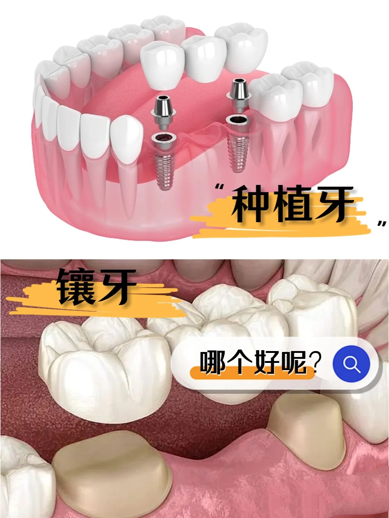 HOTBEST Pair Teeth Veneers Perfect Smile Upper And Lower Veneers Teeth ...