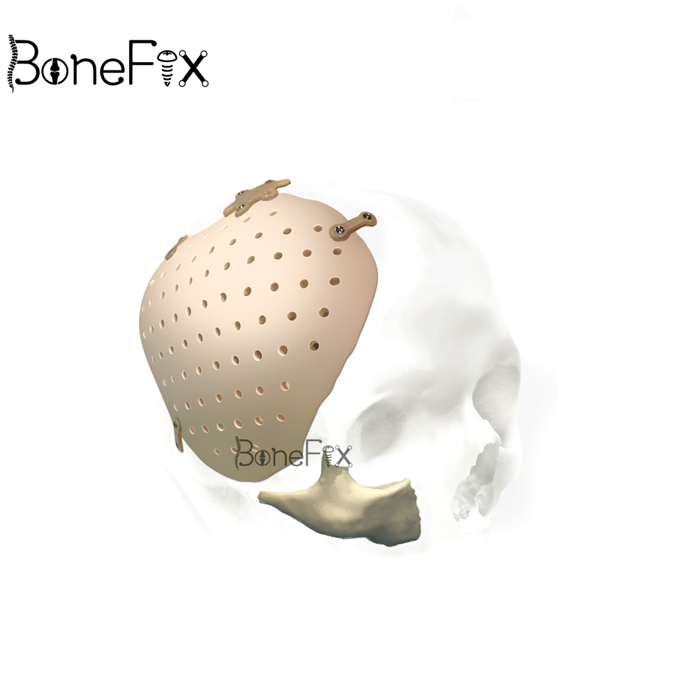 BoneFix-PEEK