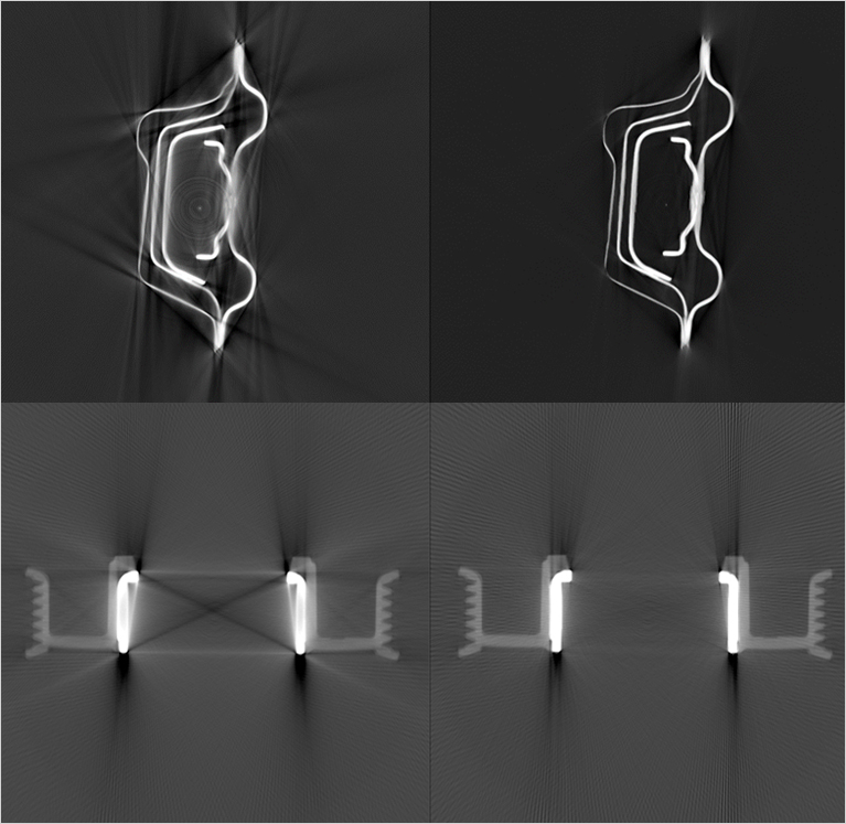 Metal Artifacts Reduction Optimization Effect Graph